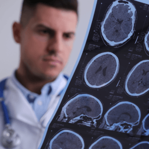 MS and SSDI